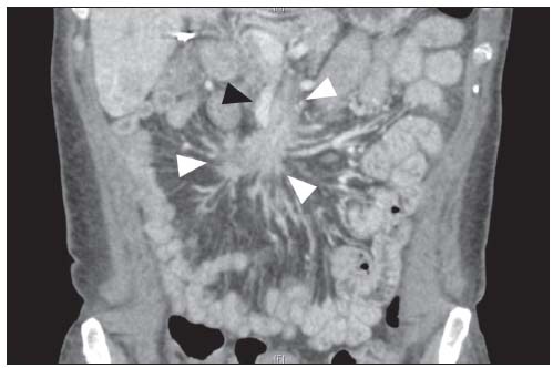 Usually on CT scan, a spider-like/crab-like change (Arrow heads) is visible in the mesentery due to the fibrosis from the release of serotonin.