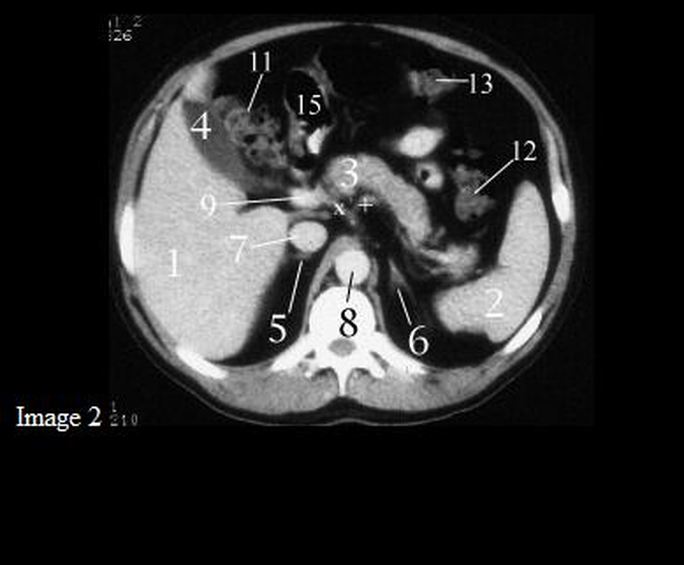  Identification of Basic Structures on Abdominal CT Scan:   (1) Liver.  (2) Spleen   (3) Pancreas: head (3+ on images), body, tail (3*), and uncinate process (3-)  (4) Gallbladder  (5) Right Adrenal Gland  (6) Left Adrenal Gland  (7) Inferior Vena Cava  (8) Aorta  (9) Portal Vein  (10) Superior Mesenteric Artery  (10*) Superior Mesenteric   (11) Ascending Colon     (12) Descending Colon  (13) Transverse Colon  (14) Stomach  (15) Distal Stomach  (16) Right Kidney  (17) Left Kidney  (18) Inferior Mesenteric Artery  (19) Duodenum, 2nd part  (19*) Duodenum, 3rd part  (20) Left Renal Vein  (20*) Left Renal Artery  (21) Rt. Renal Vein (21*) Rt. Renal Artery (22) Small Intestine (+) Splenic Artery (x) Common Hepatic Artery (#) Celiac   (*) Splenic Vein     