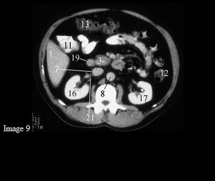  Identification of Basic Structures on Abdominal CT Scan:   (1) Liver.  (2) Spleen   (3) Pancreas: head (3+ on images), body, tail (3*), and uncinate process (3-)  (4) Gallbladder  (5) Right Adrenal Gland  (6) Left Adrenal Gland  (7) Inferior Vena Cava  (8) Aorta  (9) Portal Vein  (10) Superior Mesenteric Artery  (10*) Superior Mesenteric   (11) Ascending Colon     (12) Descending Colon  (13) Transverse Colon  (14) Stomach  (15) Distal Stomach  (16) Right Kidney  (17) Left Kidney  (18) Inferior Mesenteric Artery  (19) Duodenum, 2nd part  (19*) Duodenum, 3rd part  (20) Left Renal Vein  (20*) Left Renal Artery  (21) Rt. Renal Vein (21*) Rt. Renal Artery (22) Small Intestine (+) Splenic Artery (x) Common Hepatic Artery (#) Celiac   (*) Splenic Vein     